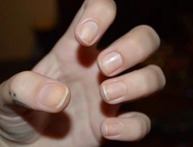 Μύκητες στα νύχια: Αίτια και αντιμετώπιση